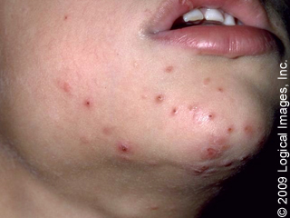 Recurring facial rashes Ametuer fisting vids